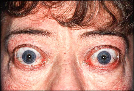 Fig 1. Middelaldrende kvinne med typisk eksoftalmus bilateralt på grunn av endokrin oftalmopati. Pasienten ble operert på grunn av vedvarende plagsomme øyesymptomer med lukningsdefekt av øyelokkene.